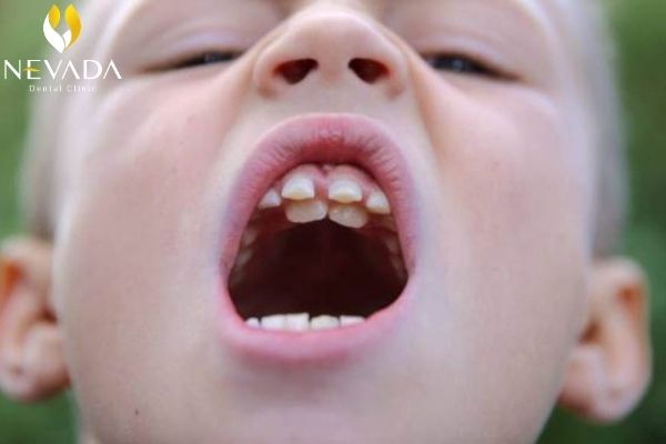 bé mọc răng đôi, mọc răng đôi, trẻ mọc răng đôi, mọc răng sinh đôi, răng mọc chẻ đôi, trẻ mọc hàm răng đôi