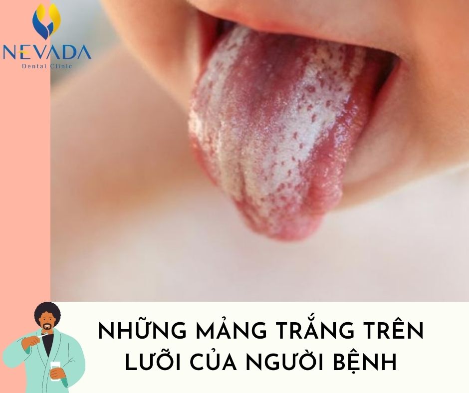 bệnh nấm lưỡi gây hôi miệng, nấm lưỡi hôi miệng, nấm lưỡi gây hôi miệng, nấm lưỡi có gây hôi miệng không, rêu lưỡi trắng hôi miệng, hôi miệng từ lưỡi