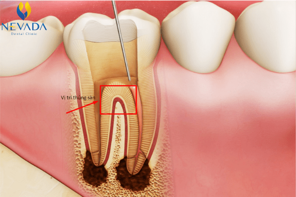 điều trị răng sâu bị thủng sàn, răng sâu bị thủng sàn, răng thủng sàn, sâu răng thủng sàn, răng sâu bị thủng sàn, điều trị răng thủng sàn, xử lý răng thủng sàn, thủng sàn răng là gì, thủng sàn răng sữa, răng bị thủng sàn, hình ảnh răng bị thủng sàn, điều trị răng bị thủng sàn, dấu hiệu thủng sàn răng