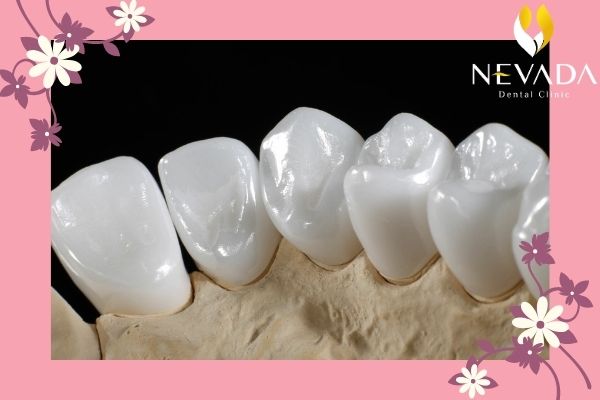 làm răng sứ đẹp tự nhiên, răng sứ tự nhiên, màu răng sứ tự nhiên nhất, răng sứ đẹp tự nhiên nhất, màu răng sứ tự nhiên, bọc răng sứ tự nhiên, răng sứ đẹp tự nhiên