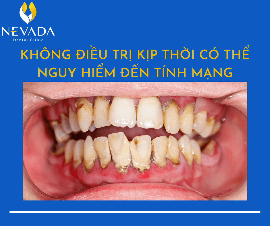 bị viêm nang răng có nguy hiểm không, nang răng có nguy hiểm không, nang răng là gì, nang răng sừng hóa, nang răng phát triển, nang răng có cuống, nang răng hàm, nang răng ở trẻ sơ sinh, nang răng, nang răng trẻ sơ sinh, nang răng sưng, u nang răng, phẫu thuật nang răng có đau không, chi phí mổ nang răng, viêm nang răng, phẫu thuật nạo nang răng
