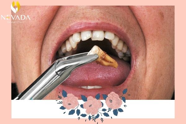 nhổ răng có làm giảm tuổi thọ không, nhổ răng có giảm tuổi thọ không, nhổ răng có bị giảm tuổi thọ không, nhổ răng khôn làm giảm tuổi thọ