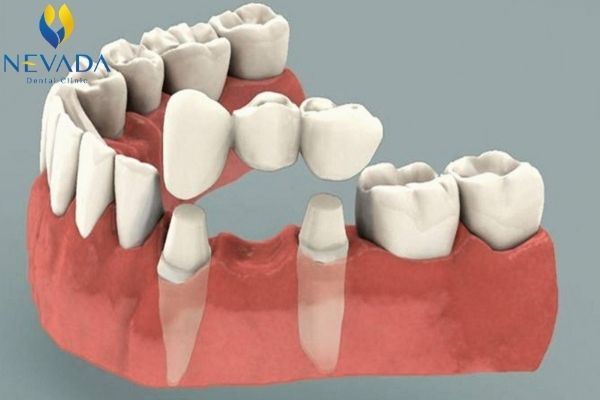 nhổ răng hàm có mọc lại không, răng hàm có mọc lại không, răng hàm nhổ có mọc lại không, răng hàm số 6 có mọc lại không, gãy răng hàm dưới có mọc lại không, nhổ răng hàm dưới có mọc lại không, trẻ bị sâu răng hàm có mọc lại không, nhổ răng hàm có mọc lại không, răng hàm có thay không, răng hàm có thay được không