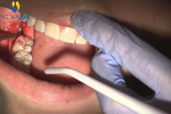 nhổ răng mọc ngầm bao nhiêu tiền, chi phí nhổ răng mọc ngầm, nhổ răng nanh mọc ngầm, nhổ răng thừa mọc ngầm, nhổ răng cửa mọc ngầm, nhổ răng khôn mọc ngầm, nhổ răng mọc ngầm có đau không, răng ngầm là gì, răng ngầm trong xương, răng ngầm ở đâu, răng mọc ngầm có nguy hiểm không, nhổ răng ngầm, mổ răng ngầm, răng mọc ngầm hàm dưới, nang răng ngầm, nhổ răng ngầm hết bao nhiêu tiền