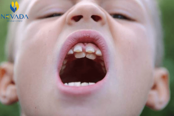 nhổ răng thừa có nguy hiểm không, nhổ răng thừa, nhổ răng thừa cho trẻ, nhổ răng thừa bao nhiêu tiền, nhổ răng thừa ở trẻ em, nhổ răng thừa giá bao nhiêu, nhổ răng mọc thừa, giá nhổ răng thừa, nhổ răng cửa thừa, có nên nhổ răng thừa không, nhổ răng thừa có đau không, chi phí nhổ răng thừa