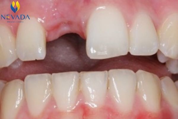 răng hàm của trẻ nhỏ có thay không, răng hàm trẻ nhỏ có thay không, ăng hàm sữa có thay ko, răng hàm có thay như răng sữa không, răng hàm của bé có thay không, răng hàm của bé có thay k, răng cối sữa có thay không