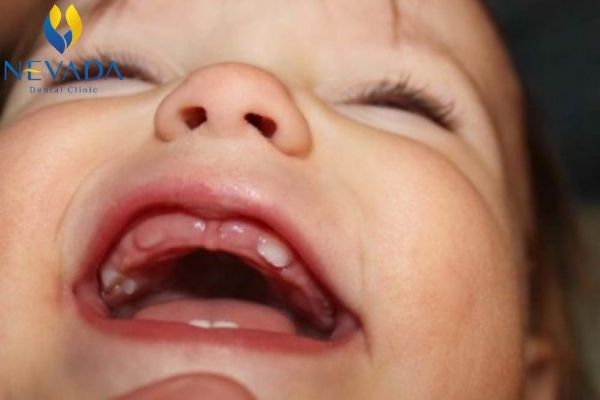trẻ mọc thiếu răng sữa, trẻ mọc thiếu răng, trẻ bị thiếu răng, bé bị thiếu mầm răng, trẻ mọc thiếu răng nanh, bé mọc thiếu răng sữa, trẻ em mọc thiếu răng sữa
