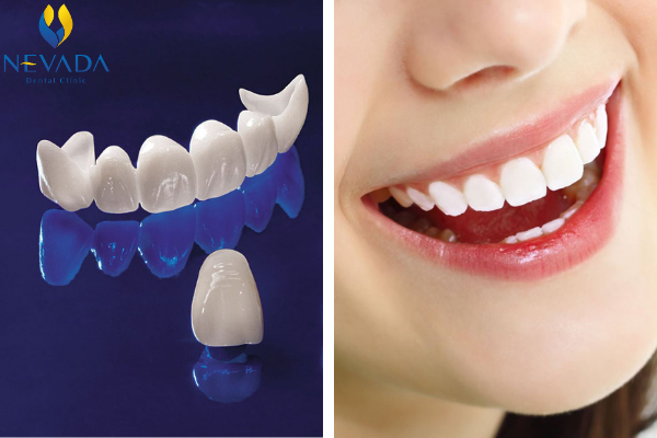 Ưu và nhược điểm của răng sứ cercon, ưu điểm của răng sứ ceron, nhược điểm của răng sứ cercon, ưu điềm răng sứ cercon, nhược điểm răng sứ cercon, ưu nhược điểm răng sứ cercon
