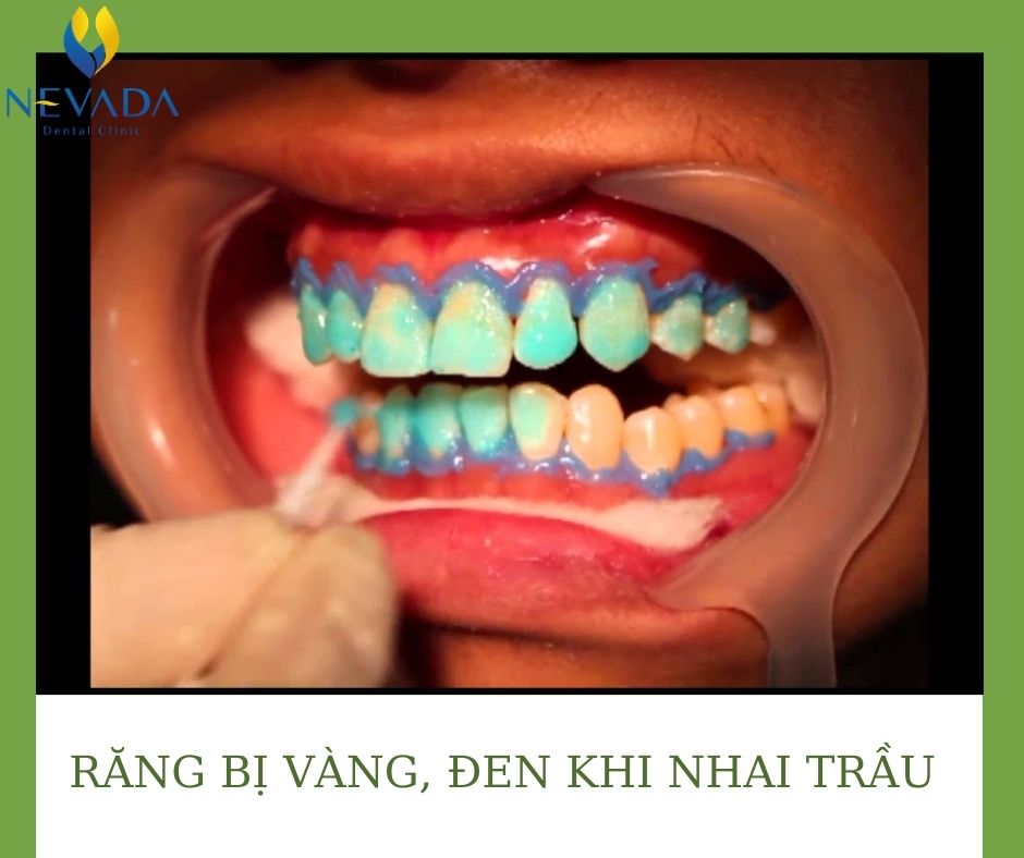 tại sao ăn trầu lại chắc răng, ăn trầu chắc răng, ăn trầu chắc răng, tại sao ăn trầu chắc răng, ăn trầu có tốt cho răng không, tại sao ăn trầu lại tốt cho răng