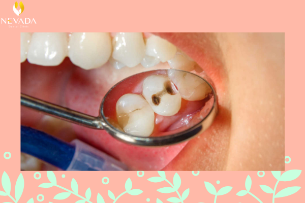 bị xiết ăn răng là gì, xiết ăn răng là gì, xiết ăn răng, bị xiết ăn răng, chữa xiết ăn răng, cách trị xiết ăn răng tại nhà, cách trị xiết ăn răng ở người lớn, cách chữa xiết ăn răng, triệu chứng bị xiết ăn răng, bé bị xiết ăn răng