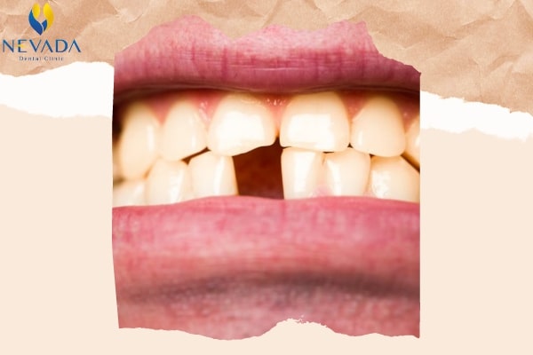 nguyên nhân bệnh rụng răng, bệnh rụng răng, bệnh nào dễ gây rụng răng sớm, chữa bệnh rụng răng, chữa bệnh rụng răng, nguyên nhân bệnh rụng răng, bệnh nào dễ gây rụng răng sớm, rụng răng là bệnh gì, bị rụng răng là bệnh gì