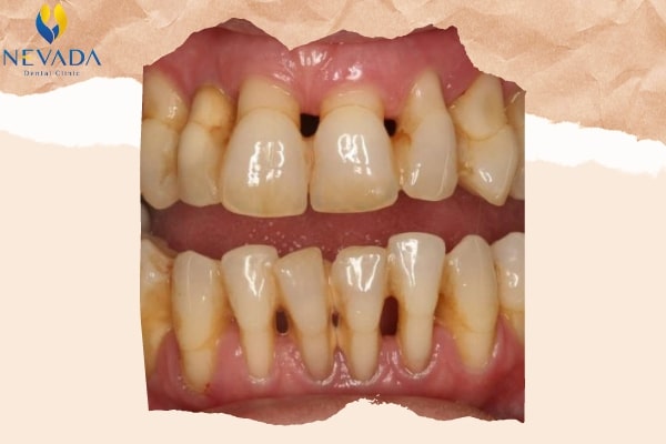 nguyên nhân bệnh rụng răng, bệnh rụng răng, bệnh nào dễ gây rụng răng sớm, chữa bệnh rụng răng, chữa bệnh rụng răng, nguyên nhân bệnh rụng răng, bệnh nào dễ gây rụng răng sớm, rụng răng là bệnh gì, bị rụng răng là bệnh gì