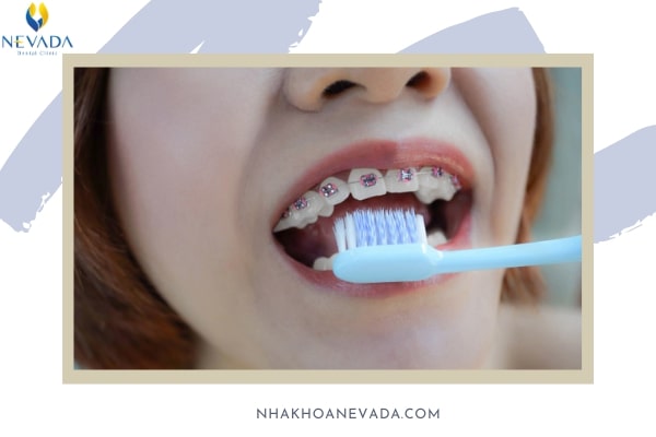 niềng răng đánh răng như thế nào, niềng răng thì đánh răng như thế nào, niềng răng nên đánh răng mấy lần, cách đánh răng cho người niềng răng, niềng răng có đánh răng được không