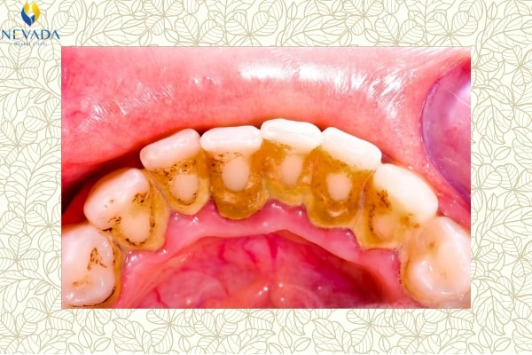 cao răng có mấy cấp độ, cao răng cấp độ 1, cao răng cấp độ 2, cao răng cấp độ 3, cao răng cấp độ 4, cao răng độ 2, cao răng độ 1