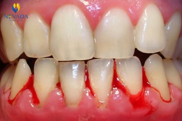 tác hại của thuốc lá đối với răng miệng, hút thuốc lá có hại cho răng không, tác hại của thuốc lá với răng miệng, tác hại của thuốc lá đối với răng miệng