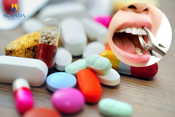 nhổ răng có cần uống kháng sinh không, nhổ răng có nên uống kháng sinh, có nên uống kháng sinh sau khi nhổ răng, nhổ răng khôn có cần uống kháng sinh không