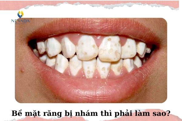 răng nhám, răng bị nhám, bề mặt răng bị nhám, răng bị nhám phải làm sao, răng bị nhám quá phải làm sao, răng bị nhám thì phải làm sao