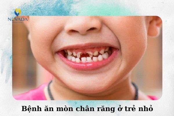 Bệnh ăn mòn chân răng ở trẻ nhỏ