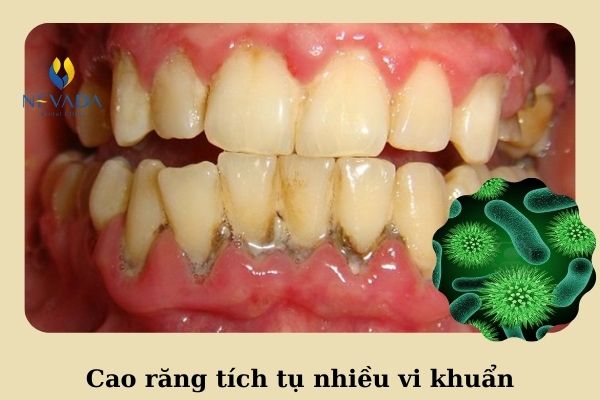 Lấy cao răng có làm hết hôi miệng không (2)