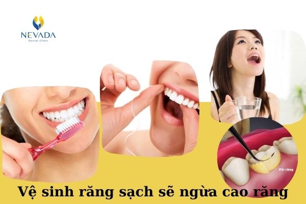 Nguyên nhân dẫn đến hình thành cao răng (1)