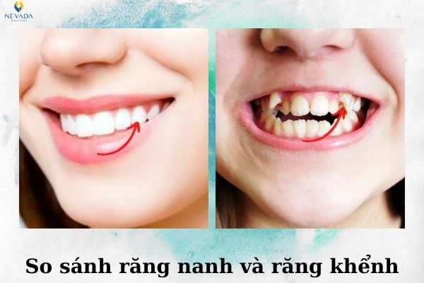 Răng khểnh và răng nanh khác nhau như thế nào (3)