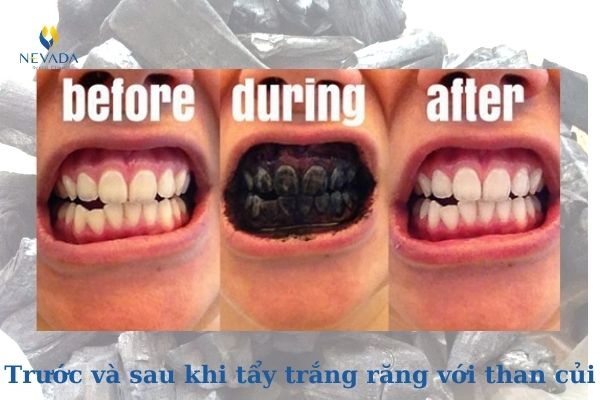 Than củi có làm trắng răng không (2)