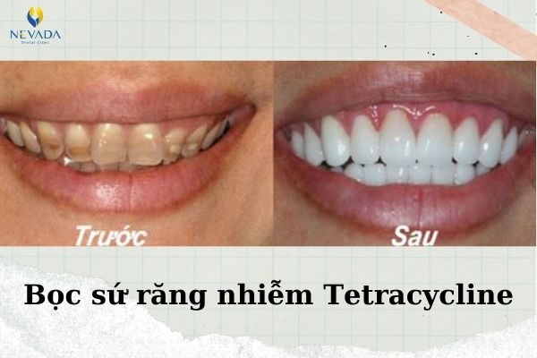 Uống kháng sinh có gây vàng răng không (4)