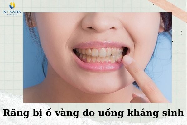 Uống kháng sinh có gây vàng răng không (5)