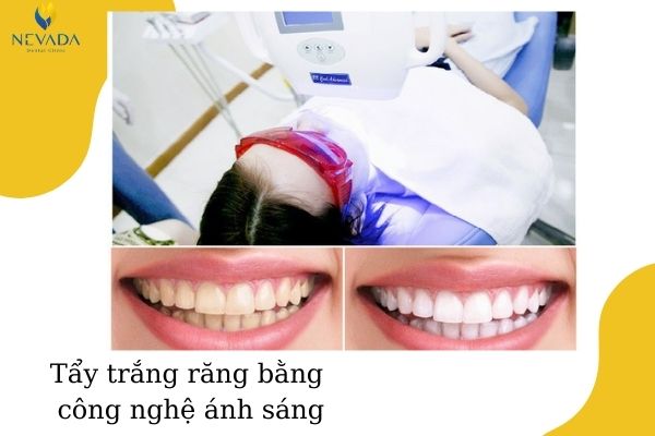 cách chữa trị vàng răng và hôi miệng (2)