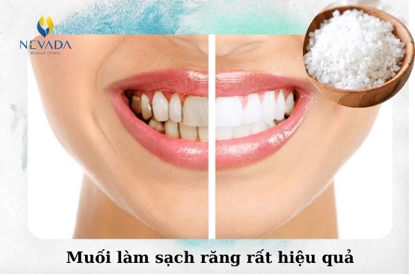 cách lấy cao răng tại nhà bằng muối (1)