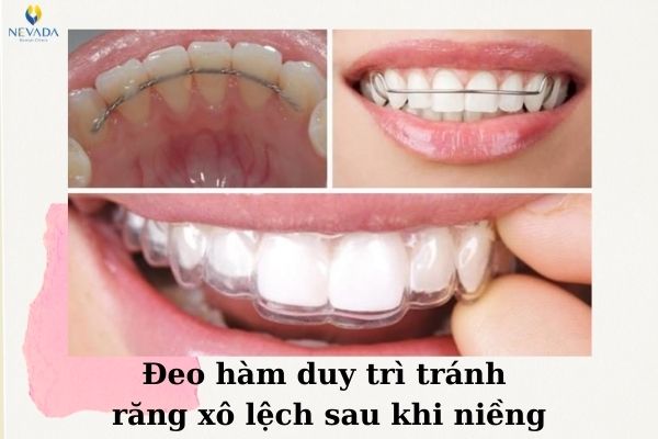 niềng răng có giúp mặt hết lệch không (3)