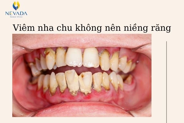 răng lung lay có niềng được không (2)