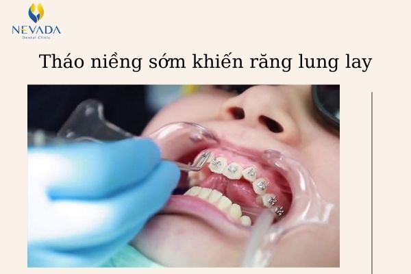 răng lung lay có niềng được không (3)