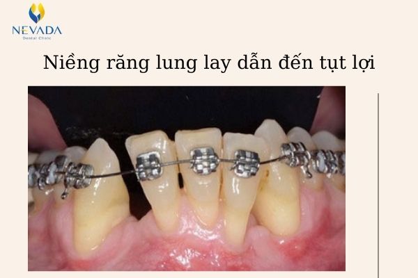răng lung lay có niềng được không (4)