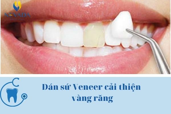răng vàng bẩm sinh có tẩy trắng được không (2)