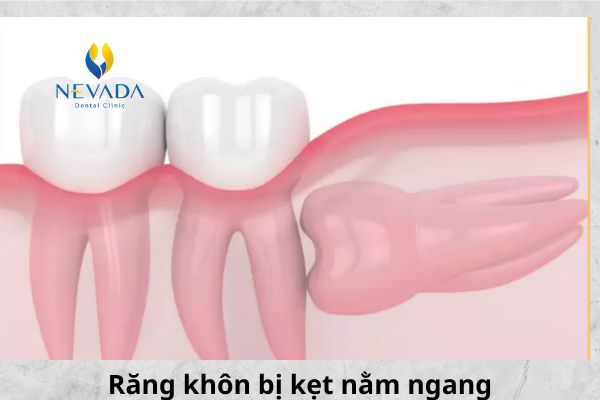 các kiểu răng khôn mọc lệch, các loại răng khôn mọc lệch, các kiểu mọc lệch của răng khôn, các dạng răng khôn mọc lệch, các trường hợp răng khôn mọc lệch