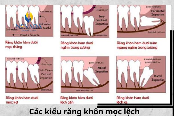 các kiểu răng khôn mọc lệch, các loại răng khôn mọc lệch, các kiểu mọc lệch của răng khôn, các dạng răng khôn mọc lệch, các trường hợp răng khôn mọc lệch