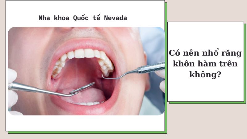 răng khôn hàm trên có nên nhổ không, nhổ răng khôn hàm trên có nguy hiểm, có nên nhổ răng khôn hàm trên không, nhổ răng khôn hàm trên nguy hiểm không, răng khôn hàm trên có nhổ được không
