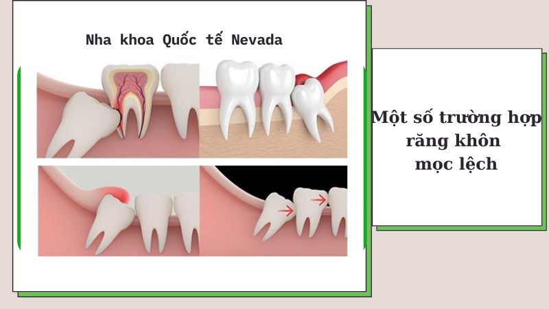 răng khôn hàm trên có nên nhổ không, nhổ răng khôn hàm trên có nguy hiểm, có nên nhổ răng khôn hàm trên không, nhổ răng khôn hàm trên nguy hiểm không, răng khôn hàm trên có nhổ được không