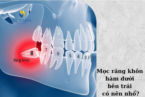 mọc răng khôn hàm dưới bên trái, mọc răng khôn hàm dưới bên trái bị sưng lợi, mọc răng khôn hàm dưới bên trái có nên nhổ, răng khôn hàm dưới bên trái dấu hiệu mọc