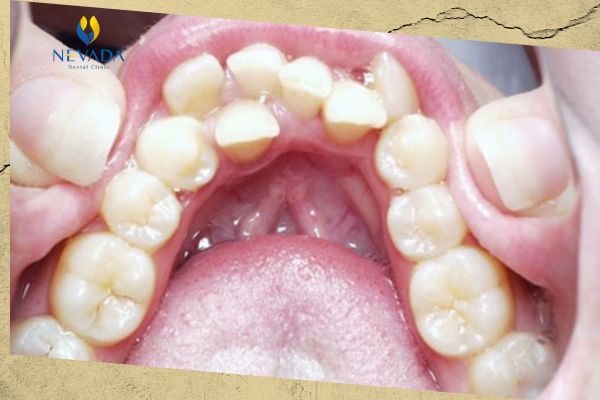 người có 36 cái răng thì sao, người có 36 cái răng, 36 cái răng, hàm răng 36 cái