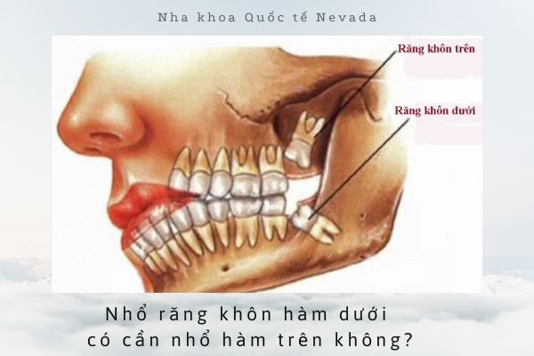 nhổ răng khôn hàm dưới có cần nhổ hàm trên, nhổ răng khôn hàm dưới có cần nhổ hàm trên không, nhổ răng khôn hàm trên hay hàm dưới nguy hiểm hơn, nhổ răng khôn hàm trên hay hàm dưới đau hơn, nhổ răng khôn hàm trên hay hàm dưới khó hơn, nhổ răng khôn hàm dưới có cần nhổ răng khôn hàm trên, nhổ răng khôn hàm dưới đau hơn hàm trên, răng khôn mọc hàm trên hay hàm dưới, mọc răng khôn hàm trên hay hàm dưới, răng khôn hàm trên hay dưới, nhổ răng khôn hàm trên và dưới