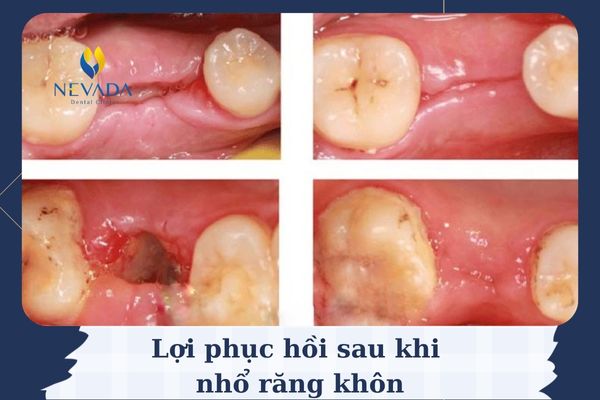 quá trình lành sau nhổ răng, quá trình lành vết nhổ răng, quá trình lành thương sau nhổ răng khôn, quá trình lành vết thương sau khi nhổ răng khôn, Quá trình lành thương sau nhổ răng