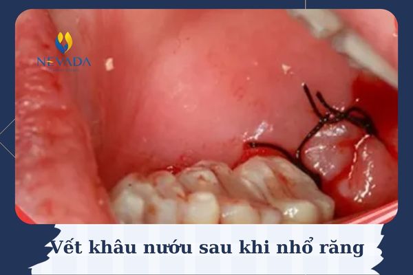 quá trình lành sau nhổ răng, quá trình lành vết nhổ răng, quá trình lành thương sau nhổ răng khôn, quá trình lành vết thương sau khi nhổ răng khôn, Quá trình lành thương sau nhổ răng