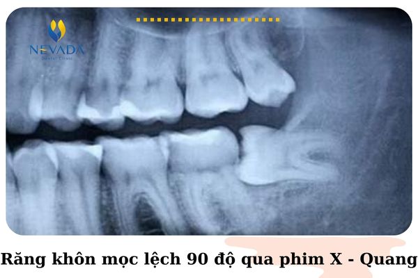 răng khôn mọc lệch 90 độ có nên nhổ không, răng khôn mọc lệch 90 độ, răng khôn mọc vuông góc, Nhổ răng khôn mọc lệch 90 độ bao nhiêu tiền