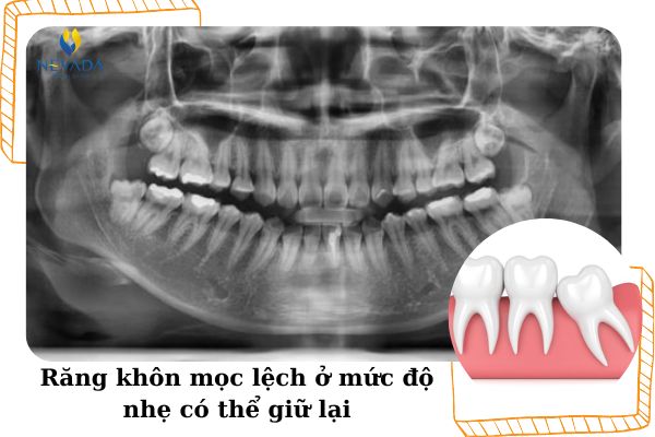răng khôn mọc lệch nhưng không đau có nên nhổ, răng khôn mọc lệch nhưng k đau, răng khôn mọc lệch không đau