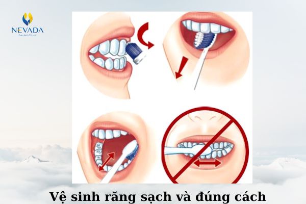 sưng nướu sau khi nhổ răng, viêm nướu sau khi nhổ răng, nhổ răng khôn bị viêm nướu, nhổ răng khôn xong bị sưng nướu, sưng lợi sau khi nhổ răng khôn, sưng lợi sau khi nhổ răng, nhổ răng khôn bị sưng lợi