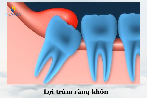 sưng nướu sau khi nhổ răng, viêm nướu sau khi nhổ răng, nhổ răng khôn bị viêm nướu, nhổ răng khôn xong bị sưng nướu, sưng lợi sau khi nhổ răng khôn, sưng lợi sau khi nhổ răng, nhổ răng khôn bị sưng lợi