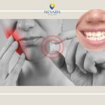 Mọc răng khôn có làm lệch hàm không? Cách phòng tránh mọc răng khôn bị lệch hàm